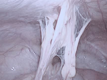 adherencias intestinales